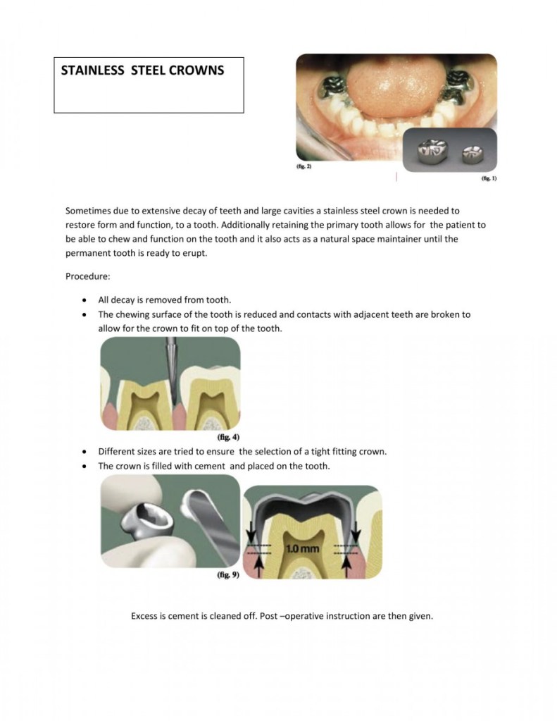 before stainless steel crowns homecare instructions