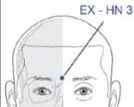 Diagram of a head highlighting acupuncture point EX-HN 3 between the eyebrows, marked with a blue dot and labeled with a diagonal line.
