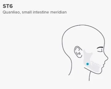 Side-view head diagram highlighting ST6 (Quanliao) point on the cheekbone, labeled as part of the small intestine meridian with a blue dot.